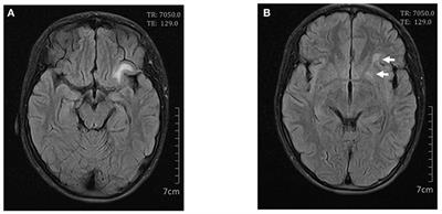 Case Report: Macrophage Activation Syndrome and Widespread Neuroimaging Abnormality in Childhood-Onset Systemic Lupus Erythematosus